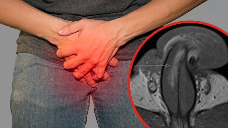 Bloke suffers the first known vertically broken penis with MRI confirming the extent of damage